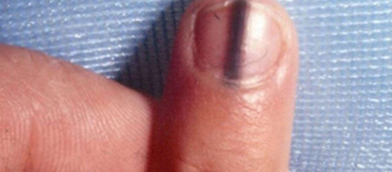 Μαύρη γραμμή στο νύχι: Τι μπορεί να σημαίνει για την υγεία σας και πως να το αντιμετωπίσετε;